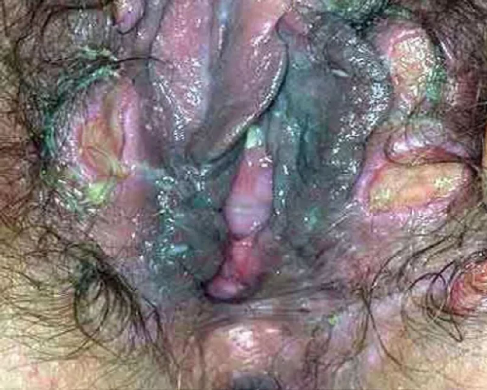 Blue waffle penis