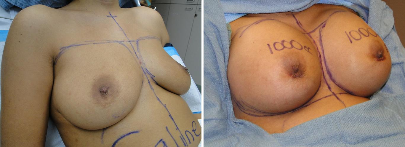 700cc breast implants photos.jpg.