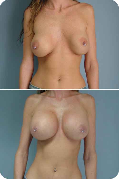 Breast Augmentation Photos.jpg