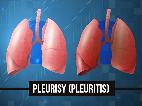 Pleurisy.jpg